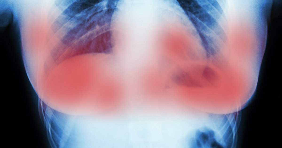 Breast cancer affect others